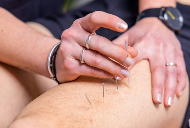 Dry needling